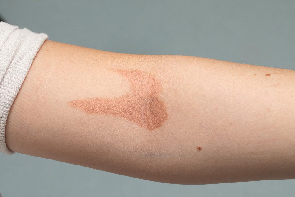 Cicatrización de queloides